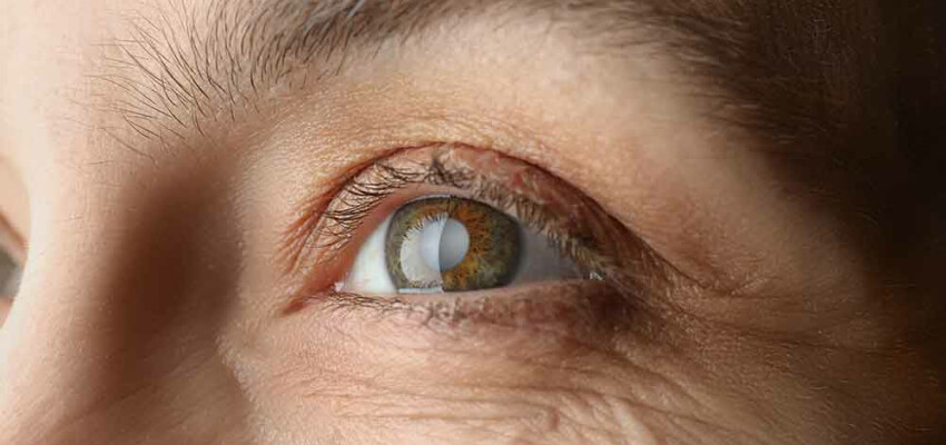 cataracte-secondaire